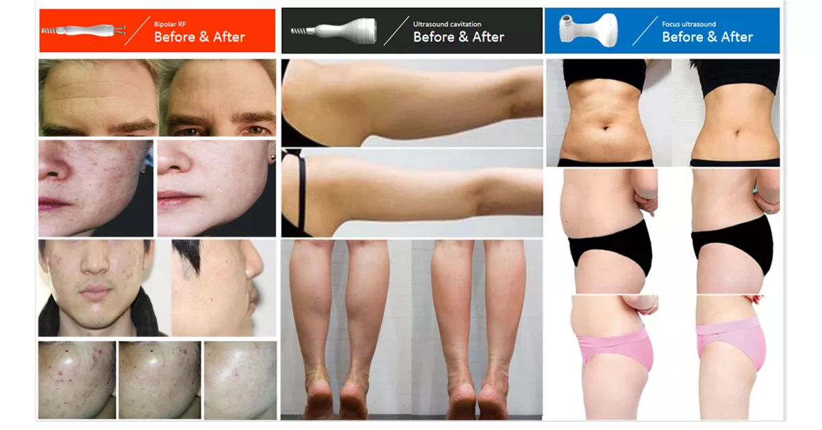 Hifu For Body Slimming Machine for slaes